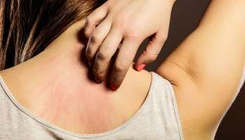 ದೇಹದ ಈ ಭಾಗದಲ್ಲಿ ತೀರಾ ತುರಿಕೆಯಾಗುತ್ತಿದರೆ... ನಿಮ್ಮ ಕಿಡ್ನಿ ಹಾಳಾಗಿದೆ ಎಂದರ್ಥ!