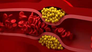 ನಿಮಗಿಷ್ಟವಾದ ಯಾವ ಆಹಾರ ಬೇಕಾದರೂ ಸೇವಿಸಿ, ನಿತ್ಯ ಇದೊಂದು ಕೆಲಸ ಮಾಡಿದರೆ ಕೊಲೆಸ್ಟ್ರಾಲ್ ಕರಗುತ್ತದೆ ! ಹಾರ್ಟ್ ಅಟ್ಯಾಕ್ ಭಯ ಬೇಡವೇ ಬೇಡ 