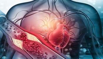 Heart Attack: ಹೃದಯಘಾತಕ್ಕೆ ಮುಖ್ಯ ಕಾರಣ ಕೊಲೆಸ್ಟ್ರಾಲ್‌ ಅಲ್ಲ! ಬೆಚ್ಚಿಬೀಳಿಸುವ ಸತ್ಯ ಬಿಚ್ಚಿಟ್ಟ ತಜ್ಞರು