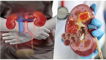Kidney failure : ಕಿಡ್ನಿ ಫೆಲ್ಯೂರ್‌ಗೆ ಈ ರುಚಿಕರ ಆಹಾರಗಳೇ ಕಾರಣ..! ಮುಂದಿನ ಬಾರಿ ಇವುಗಳನ್ನ ತಿನ್ನುವು ಮುನ್ನ ಎಚ್ಚರ..