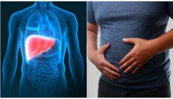 ಲಿವರ್‌ ಡ್ಯಾಮೇಜ್‌ನ ಕೊನೆಯ ಲಕ್ಷಣಗಳಿವು..! ಅಲಸ್ಯ ಮಾಡದೆ ವೈದ್ಯರ ಬಳಿ ಹೋಗಿ.. ಇಲ್ಲ ಯಮ ನಿಮ್ಮ ಬಳಿ ಬರ್ತಾನೆ