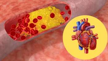 ಕೊಲೆಸ್ಟ್ರಾಲ್ ಕರಗಿಸಿ ಹಾರ್ಟ್ ಅಟ್ಯಾಕ್ ತಡೆಯಲು ಇದೊಂದು ಹಣ್ಣು ಸೇವಿಸಿ !