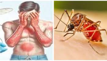 ಮಳೆಗಾಲದಲ್ಲಿಯೇ ಹೆಚ್ಚಾಗೋದು ಡೆಂಗ್ಯೂ ಸೊಳ್ಳೆಗಳ ಕಾಟ..! ದೇಹದಲ್ಲಿ ಈ ಲಕ್ಷಣಗಳು ಕಾಣಿಸಿಕೊಂಡರೆ ಜ್ವರ ಕನ್‌ಫರ್ಮ್