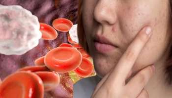 ಮುಖದಲ್ಲಿನ ಈ ಬದಲಾವಣೆ ರಕ್ತದಲ್ಲಿನ ಕೊಲೆಸ್ಟ್ರಾಲ್ ಮಟ್ಟ ಅಧಿಕವಾಗುವ ಲಕ್ಷಣ!