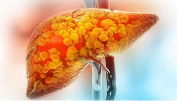 ದೇಹದಲ್ಲಿ ಈ ರೀತಿಯ ಲಕ್ಷಣಗಳು ಕಾಣಿಸಿಕೊಂಡ್ರೆ ನಿಮ್ಮ ಲಿವರ್‌ ಹಾಳಾಗುತ್ತಿದೆ ಎಂದರ್ಥ!!