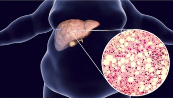 Fatty liver: ನಿಮಗೆ ಫ್ಯಾಟಿ ಲಿವರ್‌ ಇದ್ದರೆ ಆ ಮಾರಕ ಕ್ಯಾನ್ಸರ್‌ ಕಾಯಿಲೆ ಖಚಿತ