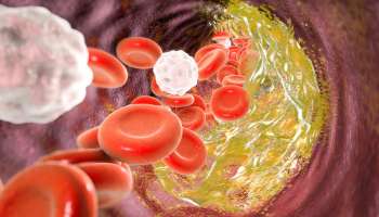 ಮೂತ್ರದಲ್ಲಿ ಈ ಎರಡೇ ಲಕ್ಷಣಗಳು ಕಂಡುಬಂದರೇ ಕೊಲೆಸ್ಟ್ರಾಲ್‌ ಹೆಚ್ಚಾಗಿದೆ ಎಂದರ್ಥ! ಅಪ್ಪಿತಪ್ಪಿಯೂ ನಿರ್ಲಕ್ಷಿಸಬೇಡಿ..