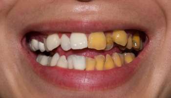 ಕಠಿಣ ಹಳದಿ ಹಲ್ಲುಗಳನ್ನು ಕ್ಷಣಾರ್ಧದಲ್ಲಿ ಬೆಳ್ಳಗಾಗುತ್ತವೆ.. ಜಸ್ಟ್‌ ಈ 5 ಸುಲಭ ವಿಧಾನಗಳನ್ನು ಅನುಸರಿಸಿ.!