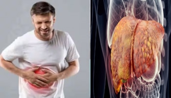 ದೇಹದಲ್ಲಿ ಈ ಲಕ್ಷಣಗಳು ಕಂಡುಬಂದ್ರೆ ನಿಮ್ಮ ಲಿವರ್‌ ಡ್ಯಾಮೇಜ್‌ ಆಗುತ್ತಿದೆ ಎಂದರ್ಥ...