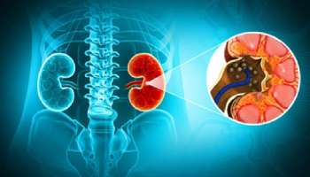 ಮೂತ್ರಪಿಂಡ ಸಮಸ್ಯೆಗೆ ಕಳಪೆ ಆಹಾರ ಪದ್ದತಿಯಲ್ಲ, ನೀವು ತಿಳಿಯದೇ ಮಾಡುವ ಈ ತಪ್ಪೇ ಕಾರಣ..! ಕಿಡ್ನಿಸ್ಟೋನ್ಸ್‌ ತಡೆಗೆ ಇಲ್ಲಿದೆ ಸೂಕ್ತ ಪರಿಹಾರ