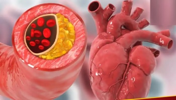 ರಕ್ತನಾಳಗಳಲ್ಲಿ ಬ್ಲಾಕೇಜ್‌ ಆದಾಗ ಕೈ ಮತ್ತು ಬೆರಳುಗಳಲ್ಲಿ ಈ ಲಕ್ಷಣಗಳು ಕಾಣಿಸಿಕೊಳ್ಳುತ್ತವೆ...