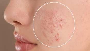 ಇದನ್ನು ಹಚ್ಚಿ ಸಾಕು.. ಮುಖದಲ್ಲಿನ ಮೊಡವೆಗಳು ಮೂರೇ ದಿನದಲ್ಲಿ ಮಾಯವಾಗುತ್ತವೆ.. ಕಲೆ ಕೂಡ ಉಳಿಯದು!