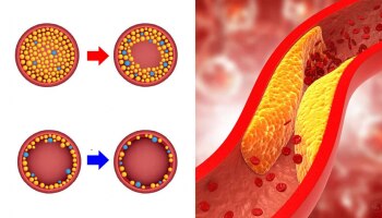 ದೇಹದಲ್ಲಿ ಕೊಲೆಸ್ಟ್ರಾಲ್ ಮಟ್ಟ ಹೆಚ್ಚುತ್ತಿದೆಯೇ? ಈ ಲಕ್ಷಣಗಳು ಕಂಡುಬಂದ್ರೆ ಎಚ್ಚರ..!