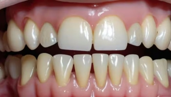 ಹಲ್ಲು ಹುಳುಕಾಗಿದ್ದರೆ ಹೀಗೆ ಮಾಡಿ, ಆಸ್ಪತ್ರೆಗೆ ಹೋಗುವ ಅಗತ್ಯವೇ ಇಲ್ಲ..!