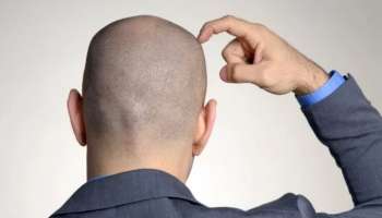 ವಿಶ್ವದಲ್ಲೇ ಅತೀ ಹೆಚ್ಚು ಬೋಳು ತಲೆ ಹೊಂದಿರುವವರು ಯಾವ ದೇಶದಲ್ಲಿದ್ದಾರೆ? ಲಿಸ್ಟ್‌ನಲ್ಲಿ ಭಾರತ-ಪಾಕಿಸ್ತಾನ ಎಲ್ಲಿವೆ ಅಂತಾ ಗೊತ್ತಾದ್ರೆ ಶಾಕ್‌ ಆಗ್ತೀರಾ.. 