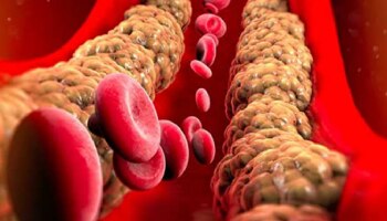 ಮಾರಕ ಕೊಲೆಸ್ಟ್ರಾಲ್‌ ಸಂಗ್ರಹವಾಗಲು ಪ್ರಮುಖ ಕಾರಣವೇ ಇದು! ನಿರ್ಲಕ್ಷಿಸಿದ್ರೆ ಜೀವಕ್ಕೆ ಅಪಾಯ...