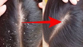 ತಲೆಹೊಟ್ಟು, ತುರಿಕೆ ಸಮಸ್ಯೆಯಿಂದ ನೀವು ಬೇಸತ್ತಿದ್ದೀರಾ? ಈ ಮನೆಮದ್ದುಗಳನ್ನ ಟ್ರೈ ಮಾಡಿ ನೋಡಿ...