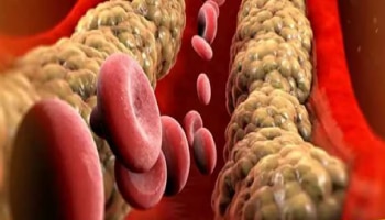 ಕೆಟ್ಟ ಕೊಲೆಸ್ಟ್ರಾಲ್ ಕಡಿಮೆ ಮಾಡಲು ಏನು ತಿನ್ನಬೇಕು?  