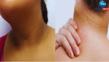 ಕುತ್ತಿಗೆಯ ಕಪ್ಪು ಕಲೆಗಳನ್ನ ನಿವಾರಿಸಲು ಇಲ್ಲಿವೆ ಸರಳ ಮನೆಮದ್ದುಗಳು