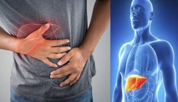 ಕೇವಲ ಅಲ್ಕೋಹಾಲ್‌ನಿಂದ ಮಾತ್ರವಲ್ಲ, ಈ ಅಭ್ಯಾಸಗಳಿಂದಲೂ ಫ್ಯಾಟಿ ಲಿವರ್ ಸಮಸ್ಯೆ ಬರುತ್ತೆ!!