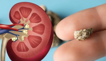 ಆಪರೇಷನ್‌ ಬೇಡವೇ ಬೇಡ.. ಈ ಜ್ಯೂಸ್‌ ಕುಡಿದ್ರೆ ಸಾಕು ತಕ್ಷಣವೇ ಕರಗುತ್ತೆ ಕಿಡ್ನಿ ಸ್ಟೋನ್!‌