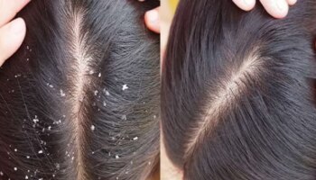 ಬೇವಿನ ಎಲೆಗೆ ಇದನ್ನ ಸೇರಿಸಿ ಹಚ್ಚಿದ್ರೆ ತಲೆಹೊಟ್ಟು ಸಮಸ್ಯೆಯಿಂದ ಮುಕ್ತಿ ಸಿಗುತ್ತೆ