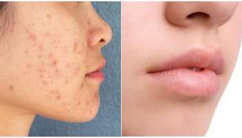 ಮುಖದ ಮೇಲೆ ಮೊಡವೆ ಕಲೆಗಳು ಹಾಗೇ ಉಳಿದಿವಿಯೇ..? ಯಾವುದೇ ಚಿಕಿತ್ಸೆ ಬೇಡ.. ಈ 6 ಸರಳ ಸಲಹೆ ಪಾಲಿಸಿ