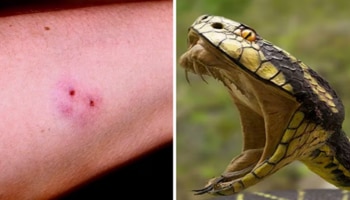 ಹಾವಿನ ವಿಷ ಹೀರಿ ಶಾಲಾ ಬಾಲಕಿಯ ಪ್ರಾಣ ಉಳಿಸಿದ ಶಿಕ್ಷಕ! 