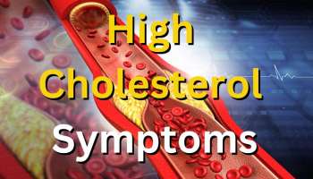 High Cholesterol Symptoms: ಈ ಅಧಿಕ ಕೊಲೆಸ್ಟ್ರಾಲ್ ಲಕ್ಷಣಗಳನ್ನು ಎಂದಿಗೂ ನಿರ್ಲಕ್ಷಿಸಬೇಡಿ 