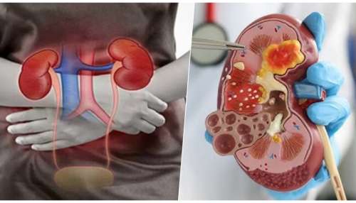 Kidney failure : ಕಿಡ್ನಿ ಫೆಲ್ಯೂರ್‌ಗೆ ಈ ರುಚಿಕರ ಆಹಾರಗಳೇ ಕಾರಣ..! ಮುಂದಿನ ಬಾರಿ ಇವುಗಳನ್ನ ತಿನ್ನುವು ಮುನ್ನ ಎಚ್ಚರ..