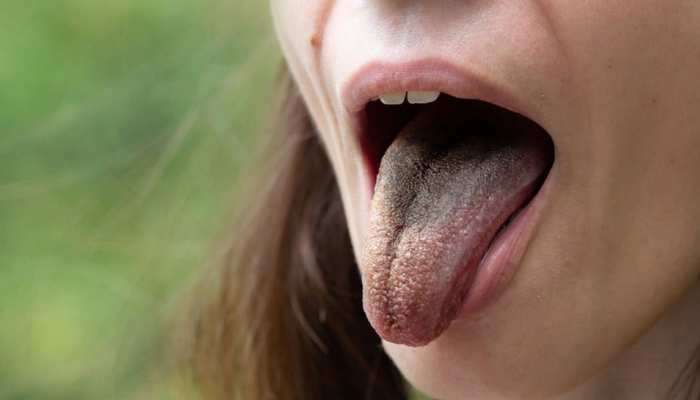 Tongue Colour: ನಾಲಿಗೆಯ ಬಣ್ಣದಲ್ಲಿ ಅಡಗಿದೆ ನಿಮ್ಮ ಆರೋಗ್ಯದ ಗುಟ್ಟು