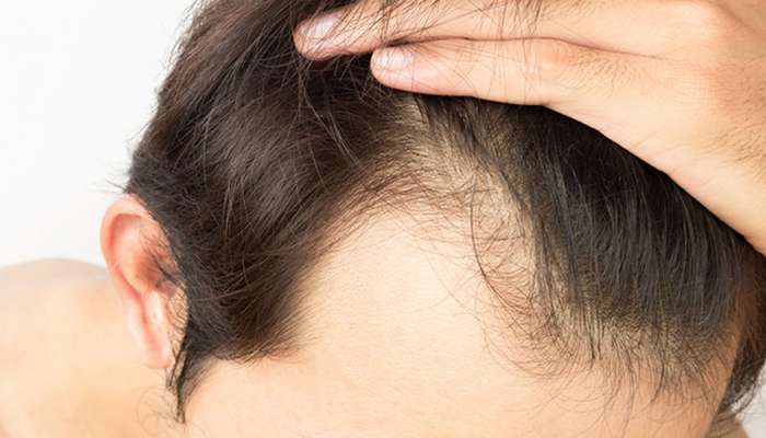Tips To Reduce Hair Fall In Men News In Kannada Latest Tips To
