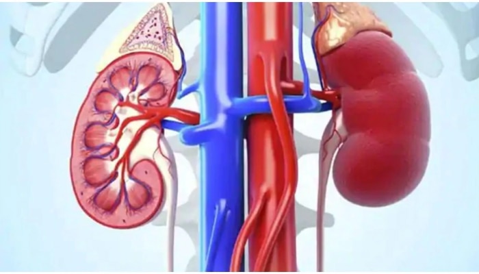 Healthy Kidney : ಕಿಡ್ನಿ ಸ್ಟೋನ್ ಗೆ   ಕಾರಣವಾಗುವ ಈ ಐದು ತಪ್ಪು ಮಾಡಲೇಬೇಡಿ.! 
