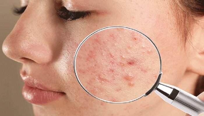 Overnight Pimple Removal: ರಾತ್ರಿ ಹೊತ್ತು ಮುಖಕ್ಕೆ ಇದನ್ನು ಹಚ್ಚಿದರೆ ಬೆಳಗಾಗುವಷ್ಟರಲ್ಲಿ ಮಾಯವಾಗುತ್ತೆ ಮೊಡವೆ