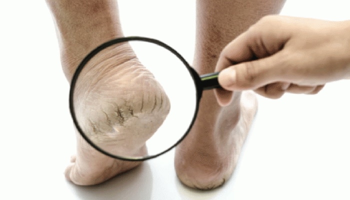 Cracked Heels Home Remedy: ಒಡೆದ ಹಿಮ್ಮಡಿಗಳನ್ನು ಬೇಗನೆ ಗುಣಪಡಿಸಲು ಇಲ್ಲಿದೆ ಸಿಂಪಲ್ ಟಿಪ್ಸ್