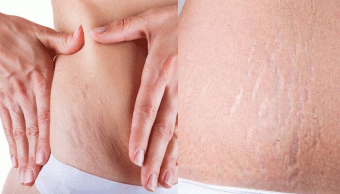 Stretch Marks Removal: ಸ್ಟ್ರೆಚ್ ಮಾರ್ಕ್ಸ್ ತೆಗೆಯಲು ಬಹಳ ಸಹಕಾರಿ ಈ 4 ವಸ್ತುಗಳು