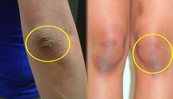 Dark Elbow and Knees: ಮೊಣಕೈ, ಮೊಣಕಾಲಿನ ಕಪ್ಪು ಕಲೆ ನಿವಾರಣೆಗೆ ಇದನ್ನೊಮ್ಮೆ ಟ್ರೈ ಮಾಡಿ