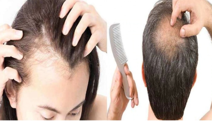 Hair Fall Treatment: ಕೂದಲು ಎಂದಿಗೂ ಉದುರಬಾರದು ಎಂದರೆ ಹೀಗೆ ಮಾಡಿ