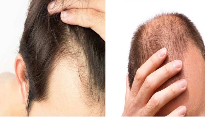 Hair loss: ಇದೇ ಕಾರಣಕ್ಕೆ ಪುರುಷರ ಕೂದಲು ಉದುರುತ್ತವೆ..!