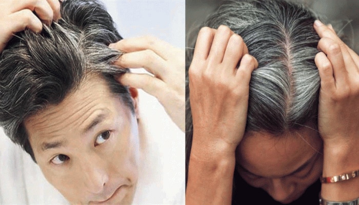 reason and remedies for white hair problem | ಅತಿ ಸಣ್ಣ ವಯಸ್ಸಿನಲ್ಲಿ ಕೂದಲು ಬೆಳ್ಳಗಾಗುವ ಕಾರಣ ಮತ್ತು ಸುಲಭ ಪರಿಹಾರ Lifestyle News in Kannada