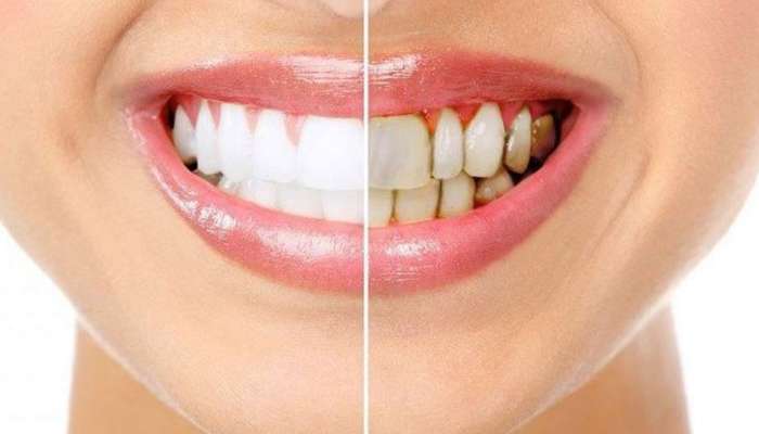 Healthy Teeth: ಆರೋಗ್ಯಕರ ಹಲ್ಲುಗಳಿಗಾಗಿ ನಿಮ್ಮ ಡಯಟ್ನಲ್ಲಿರಲಿ ಈ 2 ಆಹಾರ 