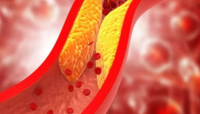 Cholesterol ಹೆಚ್ಚಳದ ಕುರಿತಾದ ಈ ಐದು ಲಕ್ಷಣಗಳನ್ನು ಲಘುವಾಗಿ ಪರಿಗಣಿಸುವ ತಪ್ಪು ಮಾಡ್ಬೇಡಿ
