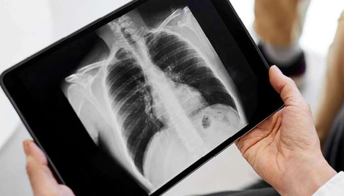 Lung Cancer: ಮಾಲಿನ್ಯದಿಂದ ದೇಹದಲ್ಲಿ ಶ್ವಾಸಕೋಶದ ಕ್ಯಾನ್ಸರ್ ಬೆಳೆಯುತ್ತಿದೆಯೇ?