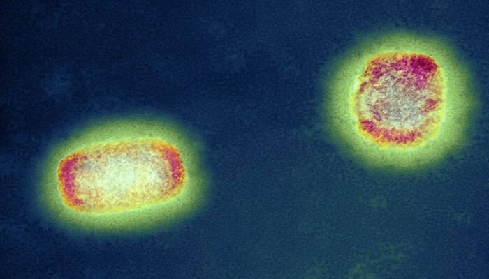 Monkeypox Virus Alert : ಕೊರೋನಾಗಿಂತ ತುಂಬಾ ಅಪಾಯಕಾರಿ ಈ ವೈರಸ್ : ICMR ನೀಡಿದೆ ಎಚ್ಚರಿಕೆ