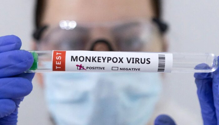 Monkeypox Latest News: ಗಾಜಿಯಾಬಾದ್ ಕದ ತಟ್ಟಿದ ಮಂಕಿಪಾಕ್ಸ್? 5 ವರ್ಷದ ಬಾಲಕಿಯಲ್ಲಿ ರೋಗ ಲಕ್ಷಣಗಳು ಪತ್ತೆ