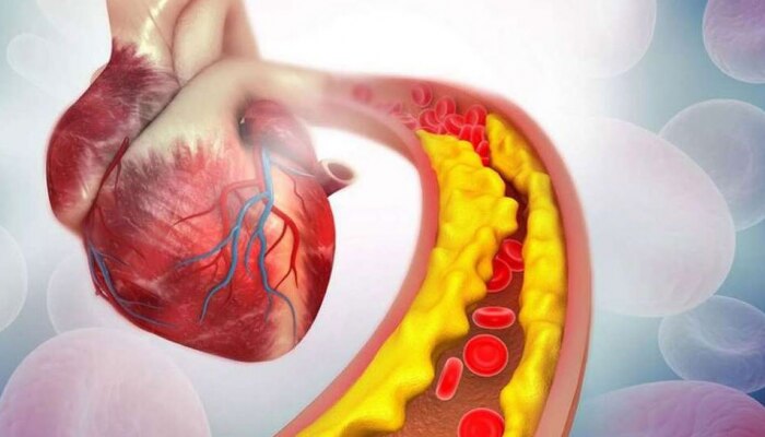 Cholesterol: ಈ ಆಹಾರ ಪದಾರ್ಥಗಳ ಸೇವನೆಯಿಂದ ಕೊಲೆಸ್ಟ್ರಾಲ್ ಹೆಚ್ಚಾಗುತ್ತದೆ, ಎಚ್ಚರ! title=