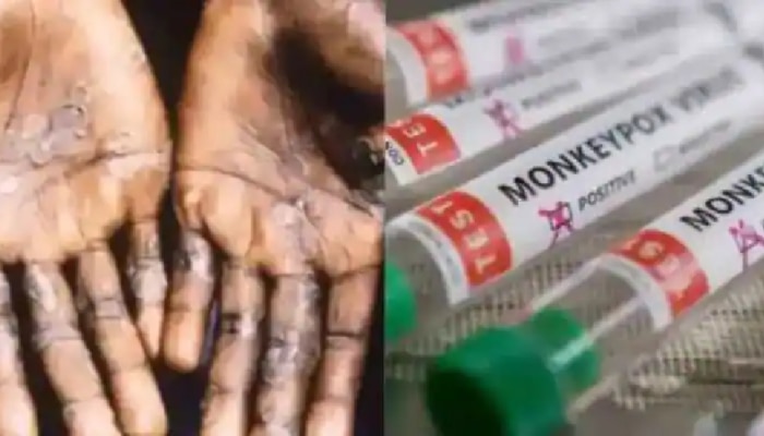 Monkeypox outbreak: ಜಾಗತಿಕ ಭೀತಿಯ ನಡುವೆ ಕೆನಡಾದಲ್ಲಿ 168 ಪ್ರಕರಣಗಳು ಪತ್ತೆ 