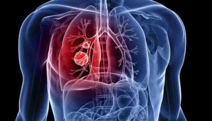 Lung Cancer: ದೇಹದಲ್ಲಿ ಈ ಬದಲಾವಣೆಗಳು ಕಂಡ ಕೂಡಲೇ ವೈದ್ಯರನ್ನು ಸಂಪರ್ಕಿಸಿ  title=