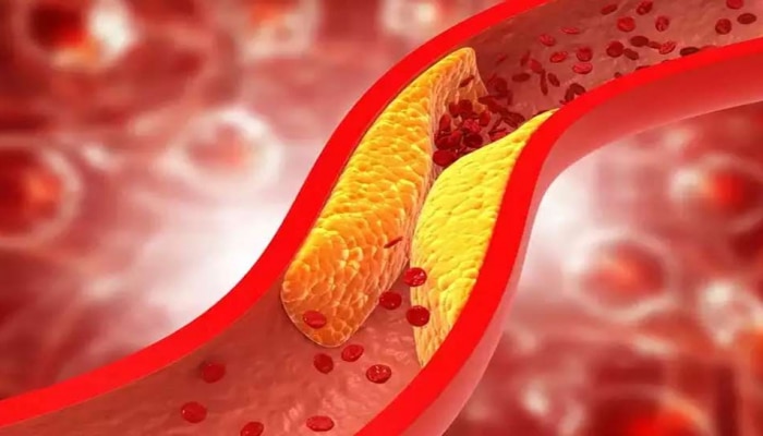 Cholesterol: ದೇಹದಲ್ಲಿ ಕೊಲೆಸ್ಟ್ರಾಲ್ ಹೆಚ್ಚಾದಾಗ ಈ ಅನುಭವಗಳಾಗುತ್ತವೆ, ನಿರ್ಲಕ್ಷಿಸಬೇಡಿ title=