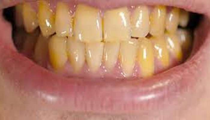 Yellow Teeth: ಈ ಹಳದಿ ವಸ್ತುವಿನಿಂದ ಹಳದಿ ಹಲ್ಲಿನ ಸಮಸ್ಯೆ ಕ್ಷಣದಲ್ಲಿ ಮಾಯವಾಗುತ್ತೆ!! 